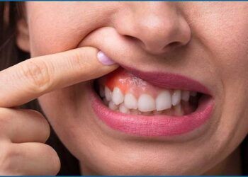 6 triệu chứng ung thư miệng dễ bị bỏ qua