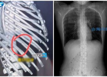 Ăn lẩu cay bị sặc ho mà cô gái trẻ gãy một lúc 4 chiếc xương sườn, bác sĩ đưa ra lý do khiến dân tình giật mình thon thót