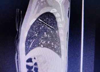 Bác sĩ kịp thời gắp kim may quần áo trong phổi bé trai 4 tuổi