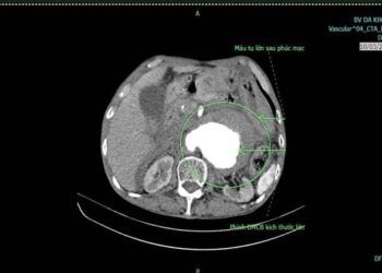 Chỉ đau lưng, đau bụng, cụ ông đột ngột ngất xỉu vì căn bệnh 'tử thần'