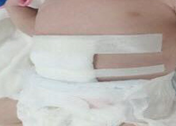 cuu song be so sinh chao doi co ruot nam ngoai o bung Phẫu thuật thành công cho bé sơ sinh chào đời có ruột nằm ngoài ổ bụng Cứu sống bé sơ sinh chào đời có ruột nằm ngoài ổ bụng