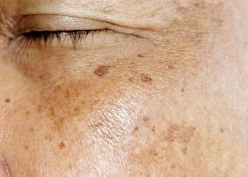 Điều gì sẽ xảy ra nếu bạn không bôi kem chống nắng