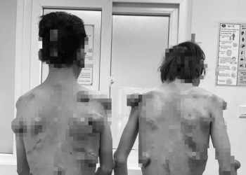 Hai anh em sinh đôi cùng trứng giống hệt nhau, cùng mang hàng trăm khối u trên người