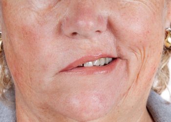 Nên làm gì khi bị liệt mặt, méo miệng do trời lạnh?