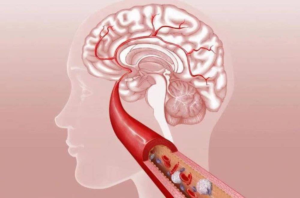 Người đàn ông 46 tuổi tử vong đột ngột vì nhồi máu não, bác sĩ nói: 3 thói quen cần thay đổi trước khi đi ngủ