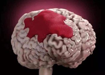 Người đàn ông 46 tuổi tử vong đột ngột vì nhồi máu não, bác sĩ nói: 3 thói quen cần thay đổi trước khi đi ngủ