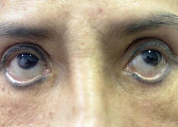 Người phụ nữ suốt ba năm "trợn mắt" vì cắt mí