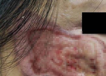 nhiem trung do mua thuoc chua axit de tri nam Một phụ nữ bị lở loét, mưng mủ mặt vì mua “thuốc chứa axit” trên mạng để trị nám Nhiễm trùng do mua “thuốc chứa axit” để trị nám