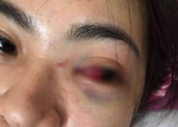 Nữ sinh lớp 11 bị nhóm bạn đánh tụ máu mắt