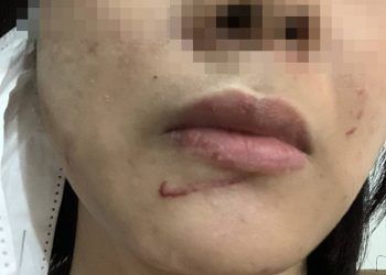 Phó trưởng công an xã đánh vợ cũ nhập viện