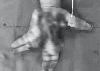 Thiếu niên 14 tuổi nát bàn tay do nổ điện thoại