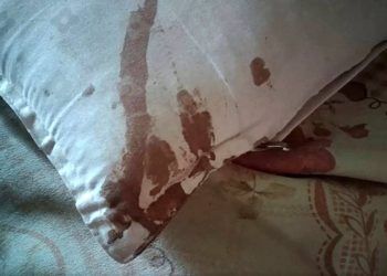 Thức giấc vì đau, người đàn ông sợ hãi thấy tai mình bị chuột cắn nham nhở