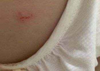 Trẻ mẫu giáo bị bạn cắn nhiều lần, trường cho nghỉ học vì 'quá áp lực'