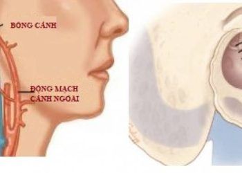 u tai co the la chi dau bao truoc ve benh tim mach nguy hiem Mối liên hệ giữa sức khỏe tim mạch và thính giác có thể gây đột quỵ Ù tai có thể là chỉ dấu báo trước về bệnh tim mạch nguy hiểm