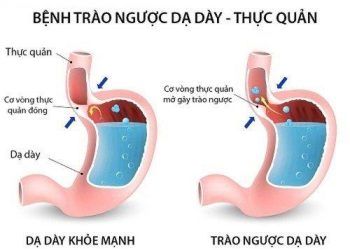 Cách nhận biết "dấu hiệu sớm" cảnh báo bệnh trào ngược dạ dày thực quản