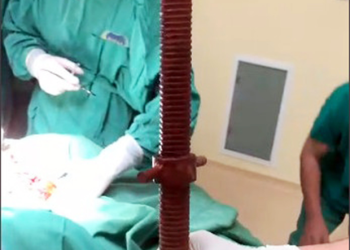 Cứu nam thanh niên bị thanh sắt đâm xuyên cổ