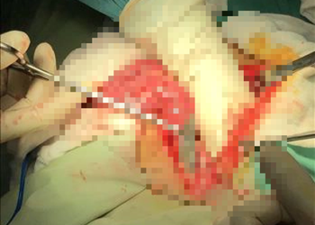 Cứu sống thanh niên nuốt lưỡi dao vào bụng