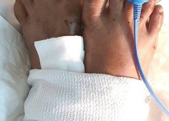 Hi hữu: Cẳng chân người đàn ông bị đứt lìa sau hơn một tuần vẫn nối thành công