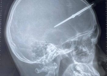 Phẫu thuật thành công cho cháu bé bị kéo đâm thủng hộp sọ