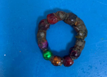 be trai bi thung ruot do nuot 14 vien bi nam cham Bé trai bị thủng ruột do nuốt... 14 viên bi nam châm Bé trai bị thủng ruột do nuốt... 14 viên bi nam châm