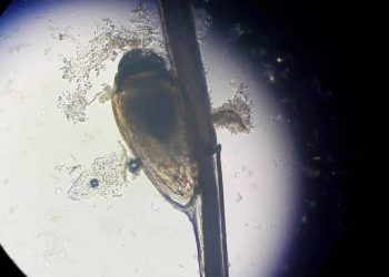 Rận ký sinh chi chít ở nách người đàn ông suốt 2 tháng