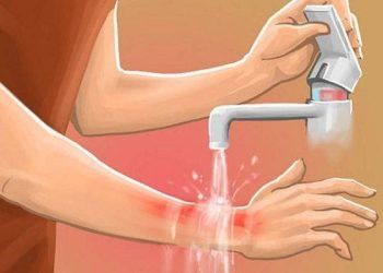 xu tri khi bi bong po xe may Cách sơ cứu nhanh khi bị bỏng pô xe máy Xử trí khi bị bỏng pô xe máy